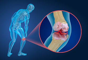 joint with osteoporosis