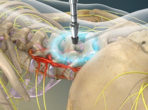 Activator methods in chiropractic care