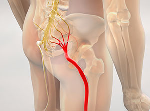 Patient suffering with sciatica